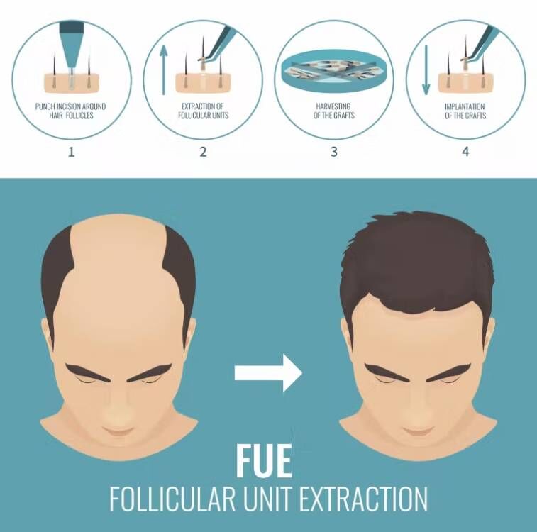 FUE Hair Implant Micro Motor H - Hair Care Vegan ulasan dan harga